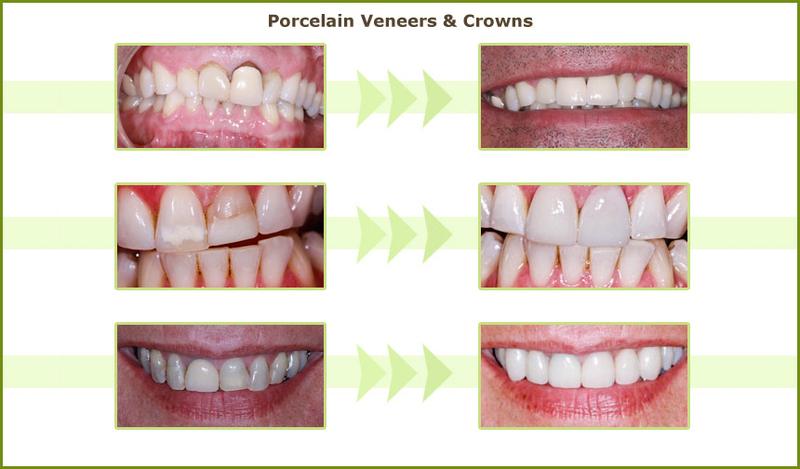 Porcelain veneers before and after