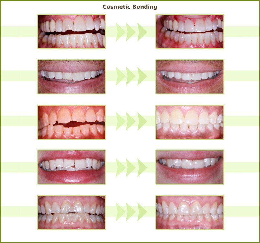 Real before and after cosmetic bonding results by Dr. Mangat