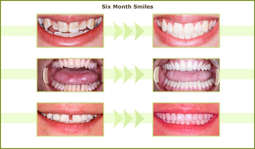 Real before and after Six Month Smiles results — three patient cases