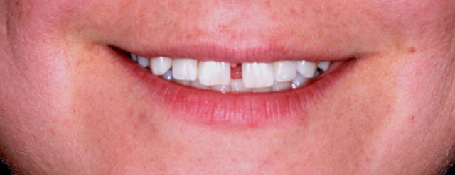 Crowded teeth before Six Month Smiles treatment