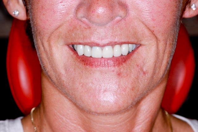 Flawless smile after porcelain veneers at Serenity Dental