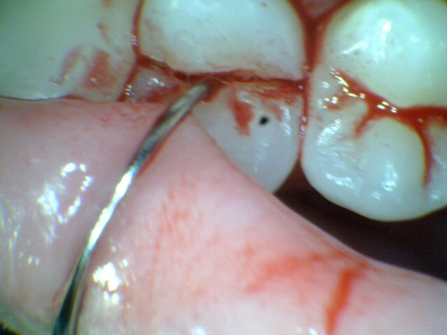 Cracked tooth caused by grinding